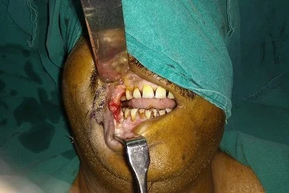 oral cancers